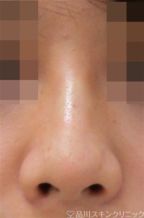 症例NO.40558のAFTER写真