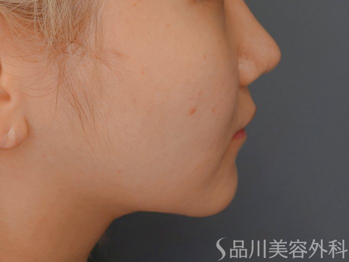 症例NO.73285のAFTER写真