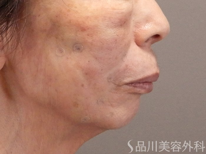 症例NO.70287のAFTER写真