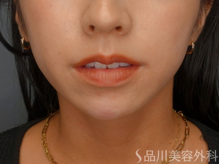 症例NO.74064のAFTER写真
