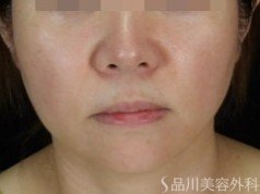 症例NO.71480のBEFORE写真