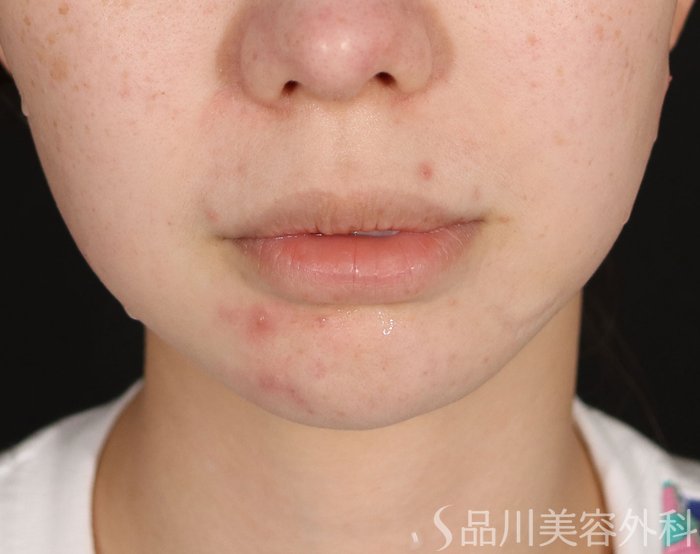 症例NO.74196のBEFORE写真