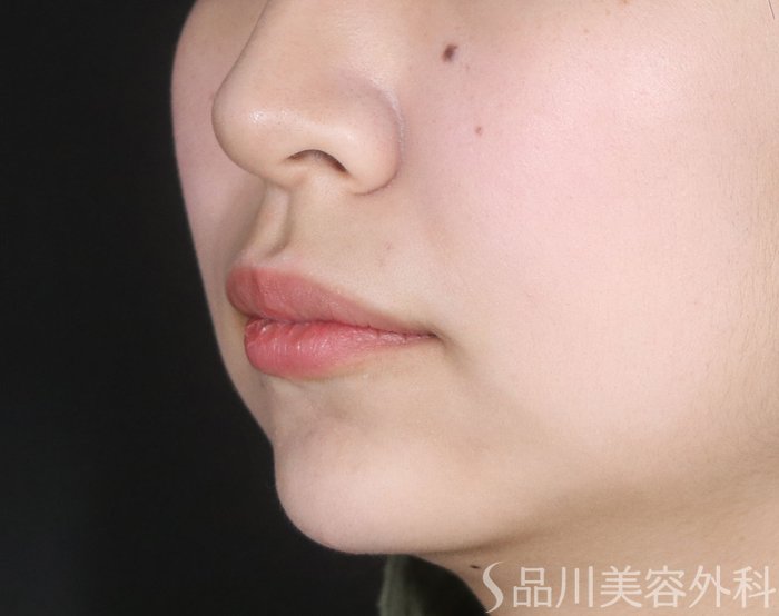 症例NO.72863のAFTER写真