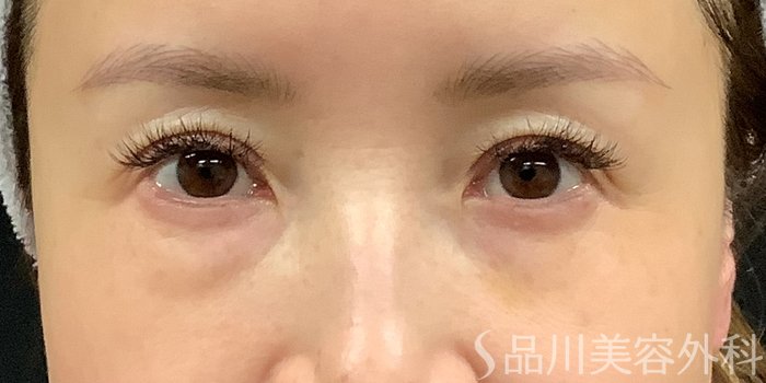 症例NO.71232のBEFORE写真
