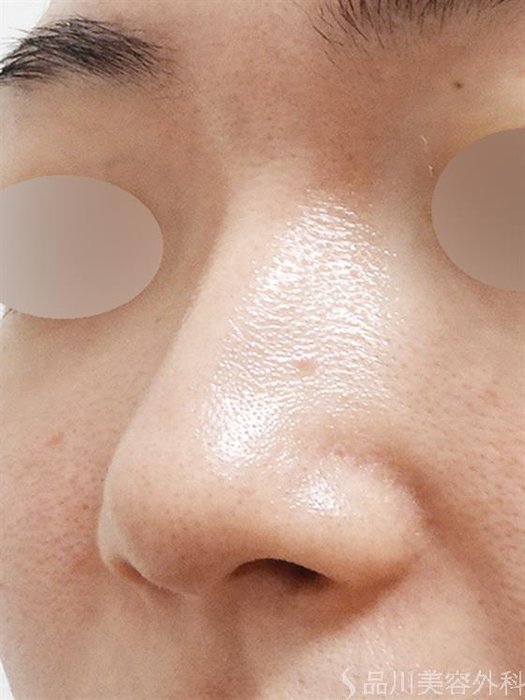 症例NO.51490のBEFORE写真