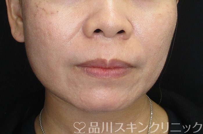 症例NO.75380のBEFORE写真