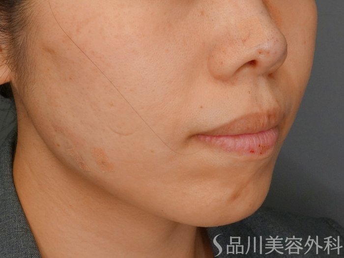 症例NO.73492のAFTER写真