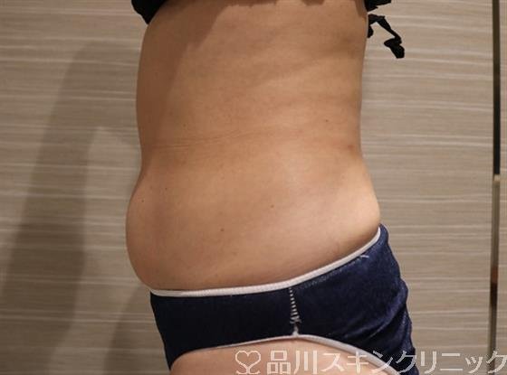 症例NO.43520のBEFORE写真