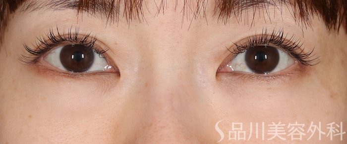 症例NO.72172のBEFORE写真