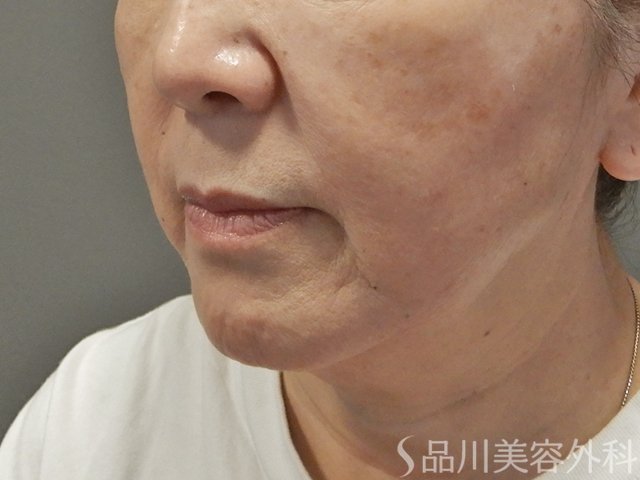 症例NO.74256のBEFORE写真