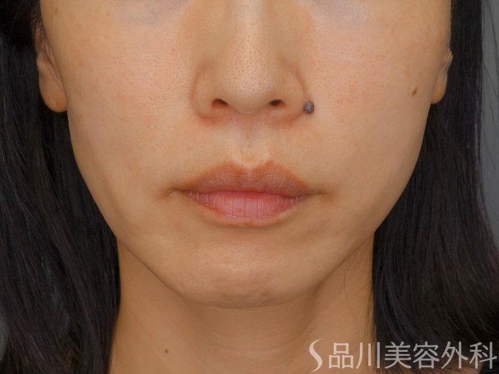 症例NO.72059のBEFORE写真