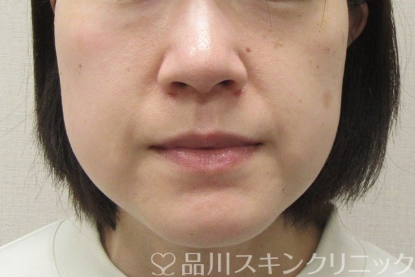 症例NO.69276のBEFORE写真