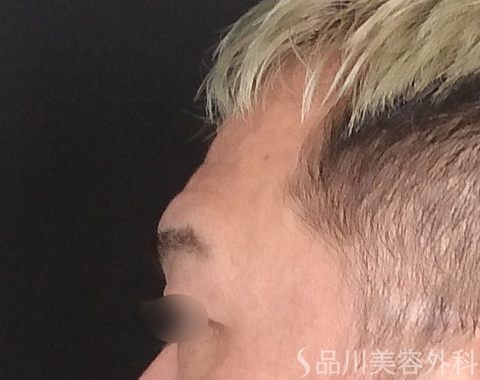 症例NO.70152のBEFORE写真