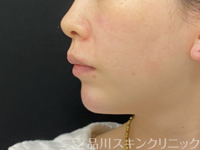 症例NO.74528のAFTER写真