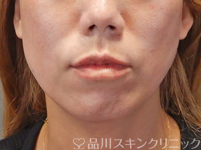 症例NO.75039のAFTER写真