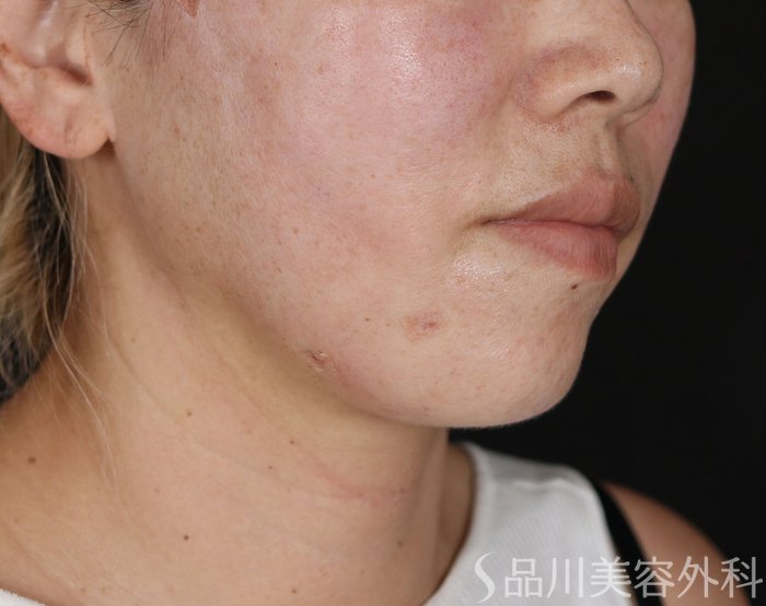 症例NO.71096のAFTER写真