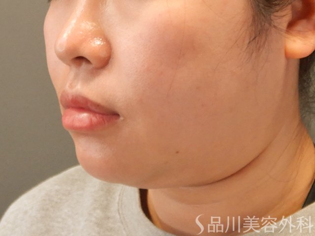 症例NO.71928のBEFORE写真