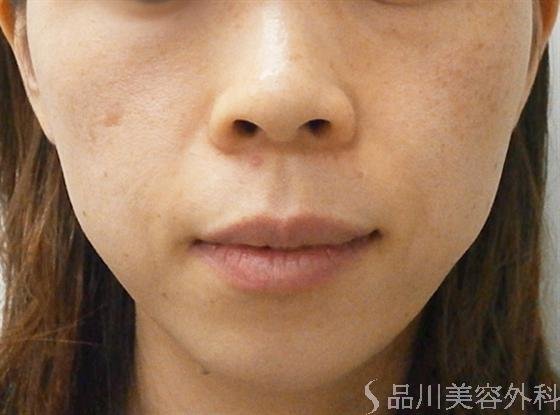 症例NO.13782のBEFORE写真