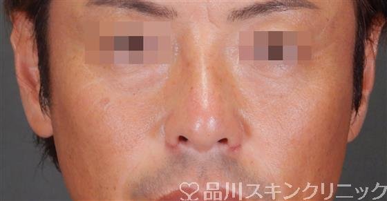 症例NO.56441のAFTER写真