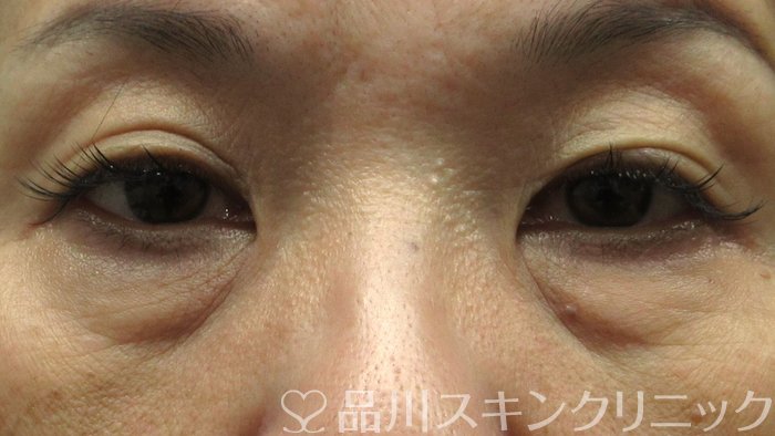 症例NO.74397のBEFORE写真