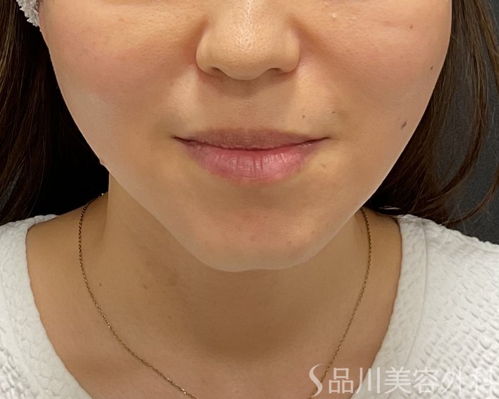 症例NO.75293のAFTER写真