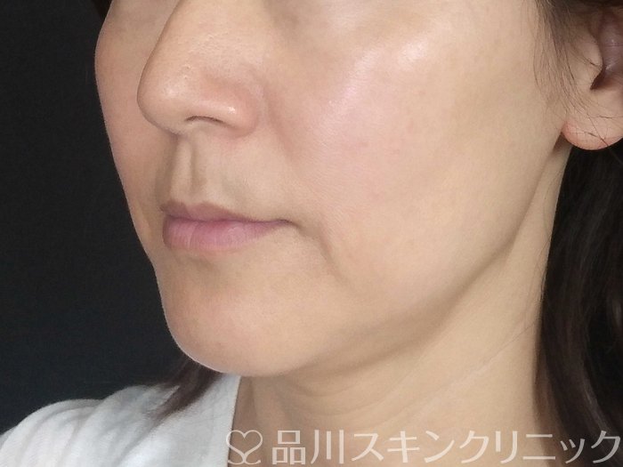 症例NO.69715のBEFORE写真