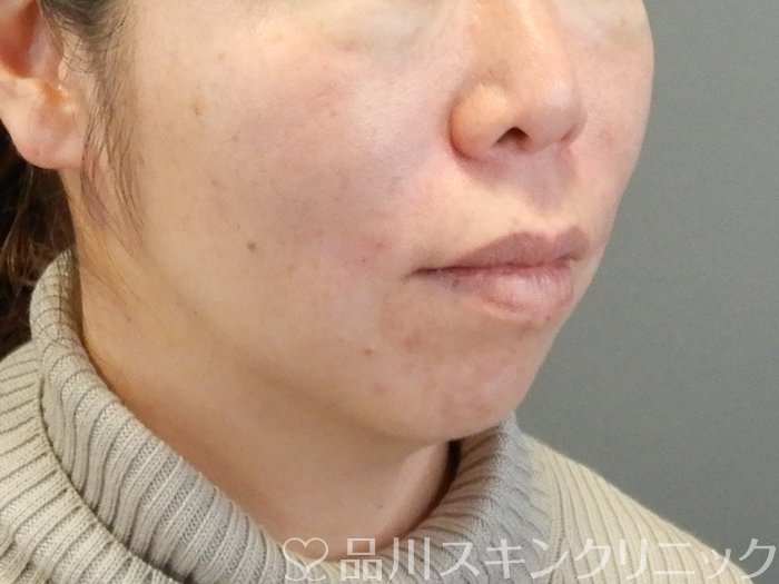 症例NO.63525のAFTER写真