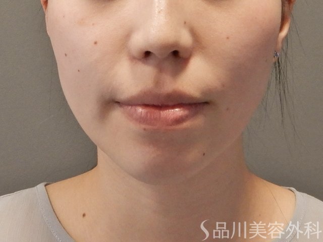 症例NO.74562のBEFORE写真