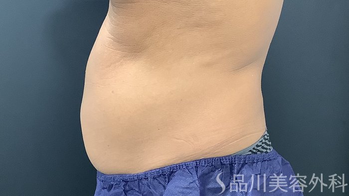 症例NO.75369のAFTER写真
