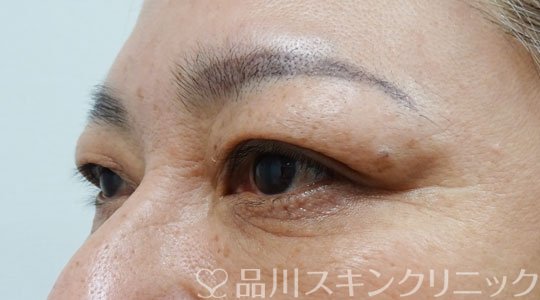 症例NO.69407のBEFORE写真