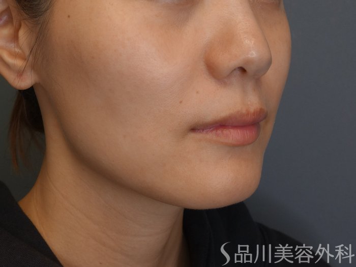 症例NO.74258のBEFORE写真