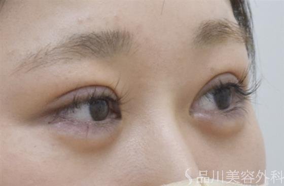 症例NO.52692のAFTER写真