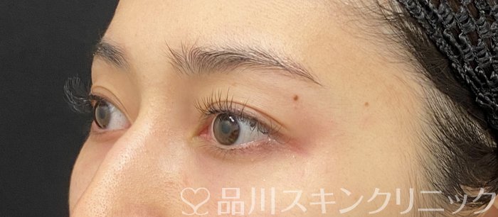 症例NO.74155のAFTER写真
