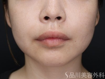 症例NO.75007のBEFORE写真