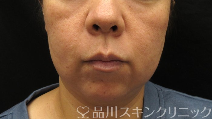 症例NO.74367のBEFORE写真