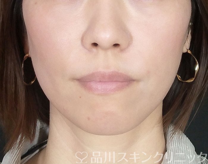 症例NO.62349のAFTER写真