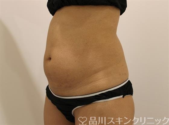 症例NO.46651のBEFORE写真