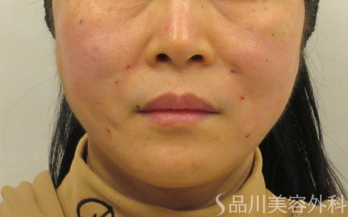 症例NO.73642のAFTER写真