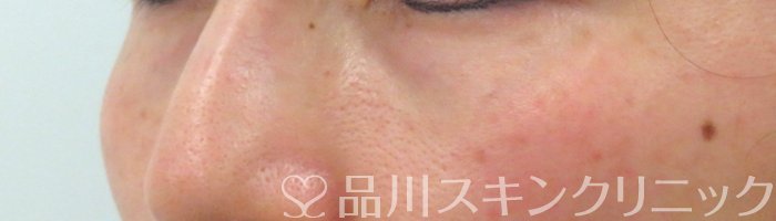 症例NO.66423のBEFORE写真