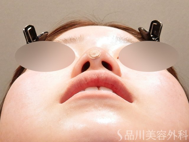 症例NO.69297のAFTER写真