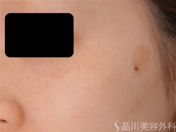 症例NO.55903のAFTER写真