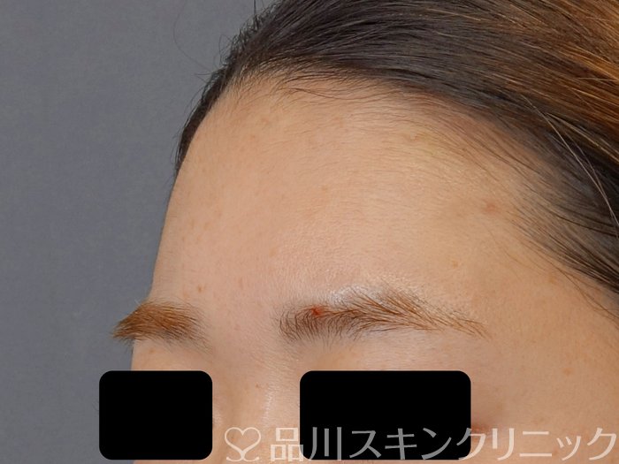 症例NO.72698のAFTER写真