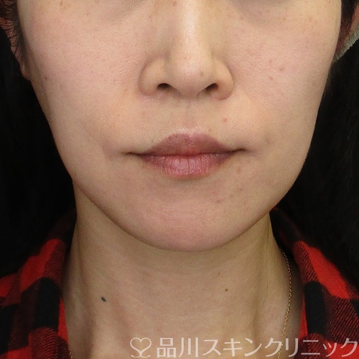 症例NO.74679のBEFORE写真