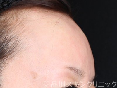 症例NO.70230のAFTER写真