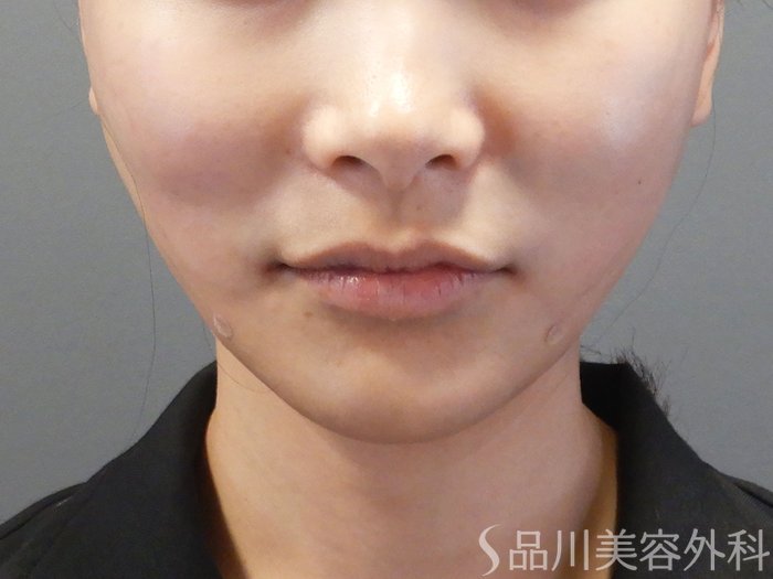 症例NO.71808のAFTER写真