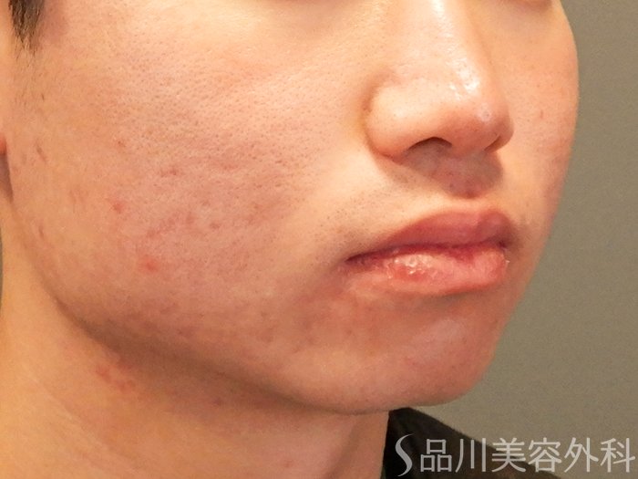 症例NO.70245のBEFORE写真