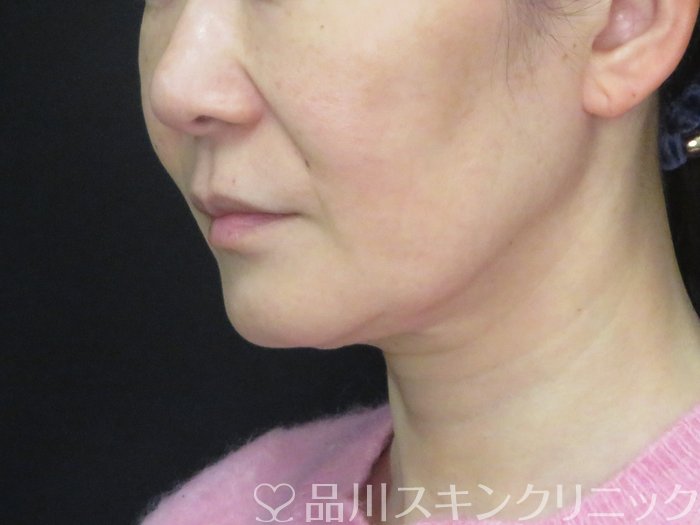 症例NO.73832のBEFORE写真