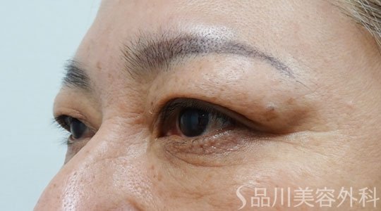 症例NO.69407のBEFORE写真