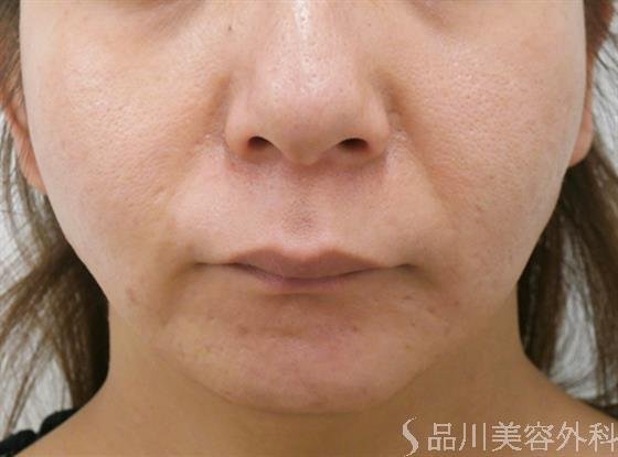 症例NO.28071のAFTER写真