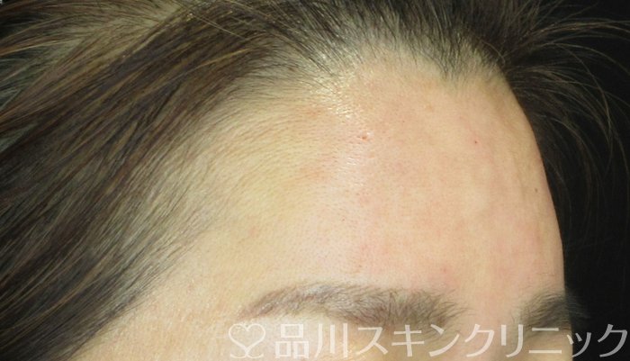 症例NO.65375のAFTER写真